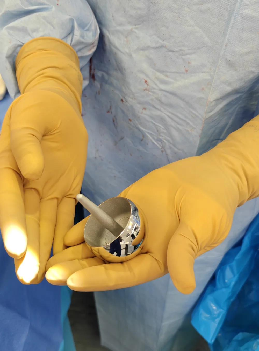 Adept metal-on-metal hip resurfacing femoral cap held in gloved hands in theatre before implantation, showing the polished cobalt-chromium shell and short central stem, Mr Shakir Hussain, Birmingham