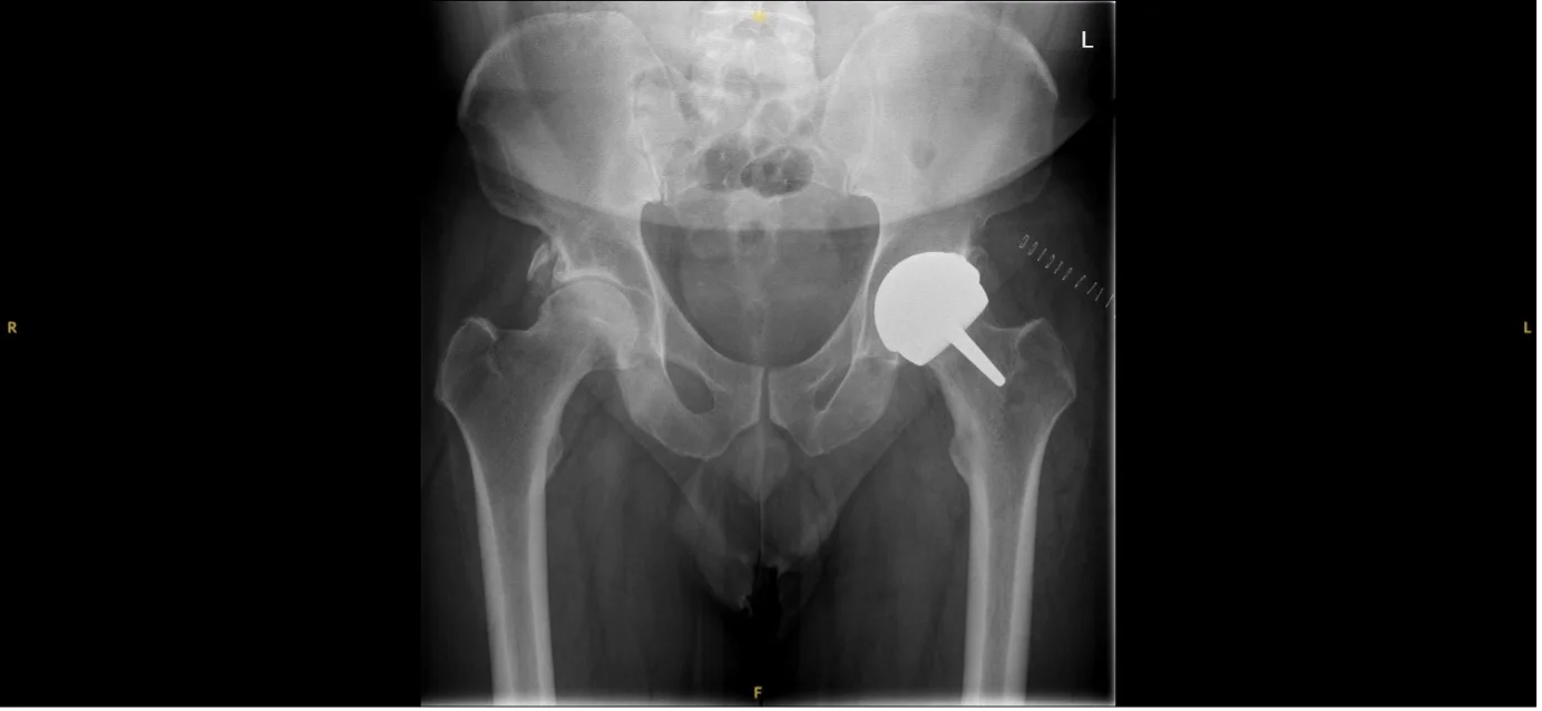 After X-ray showing a left Adept metal-on-metal hip resurfacing cap implanted by Mr Shakir Hussain, Birmingham