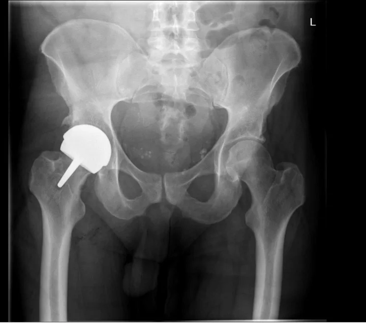 After X-ray showing a right Adept hip resurfacing cap implanted by Mr Shakir Hussain, Birmingham