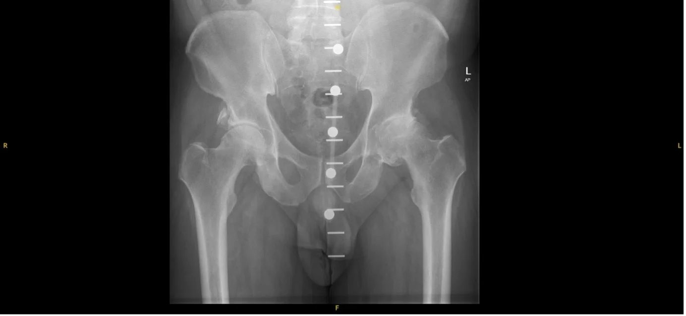 Before X-ray of a left hip with osteoarthritis prior to Adept hip resurfacing by Mr Shakir Hussain, Birmingham