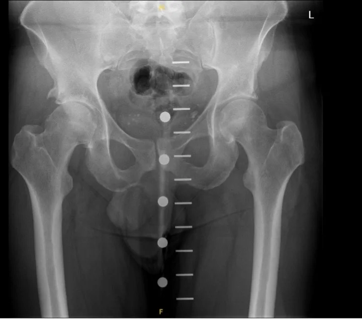 Before X-ray of a right hip with osteoarthritis prior to Adept hip resurfacing by Mr Shakir Hussain, Birmingham