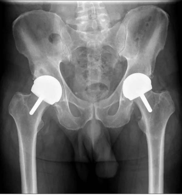 Pelvic X-ray after surgery showing both hips resurfaced with a Birmingham Hip Resurfacing