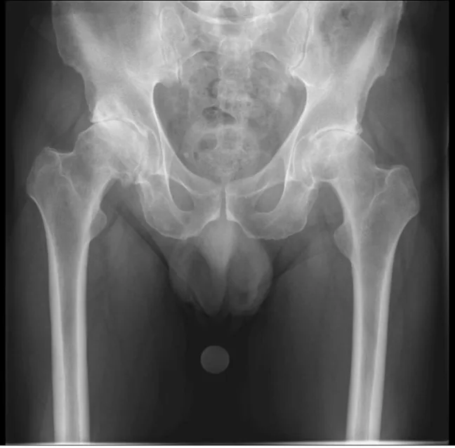 Pelvic X-ray before surgery showing osteoarthritis in both hips