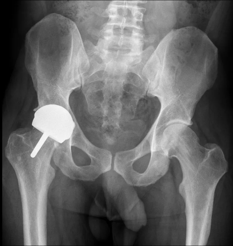 Hip X-ray after surgery showing the hip resurfaced with a Birmingham Hip Resurfacing