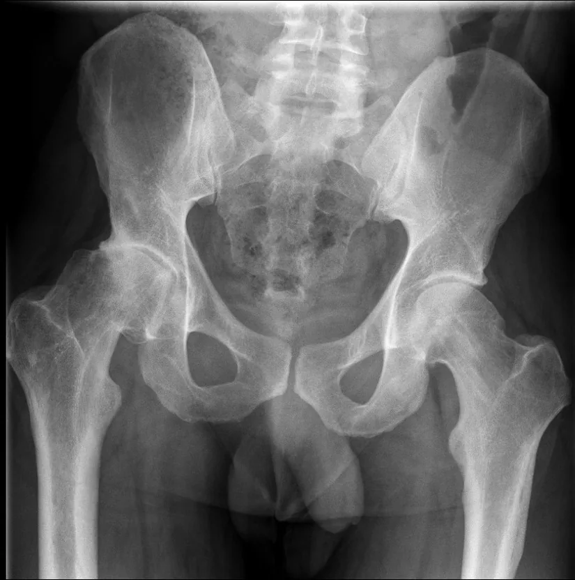 Hip X-ray before surgery showing deformity from a childhood slipped upper femoral epiphysis