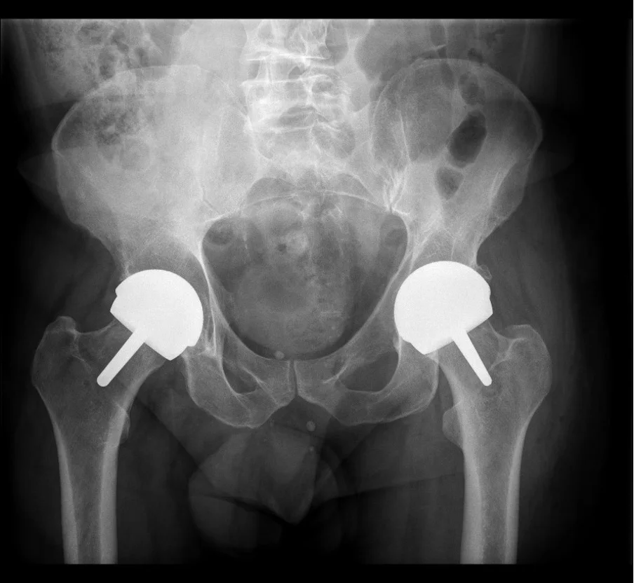 X-ray of both hips resurfaced with bilateral Adept hip resurfacing caps by Mr Shakir Hussain, Birmingham