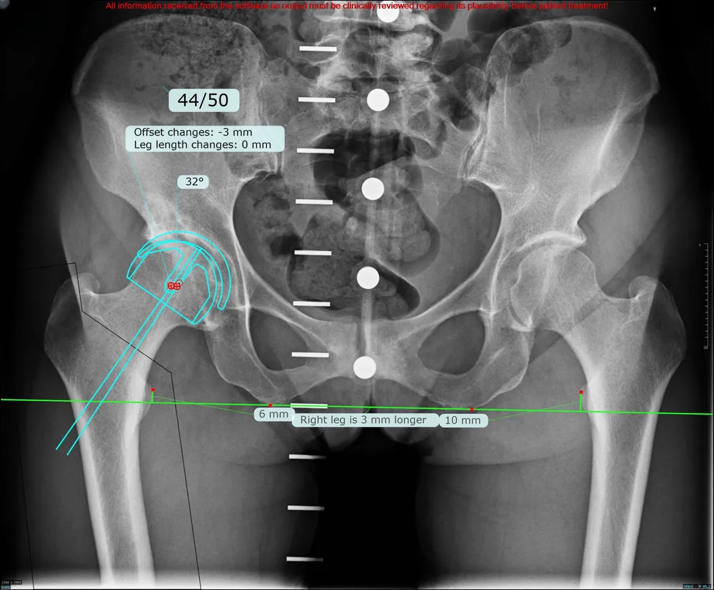 Pre-operative planning X-ray showing a 44 mm femoral head on the right hip of a woman in her late forties, too small for metal-on-metal hip resurfacing, Mr Shakir Hussain, Birmingham