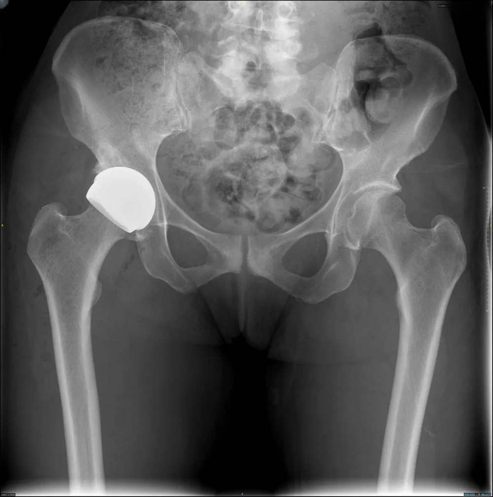 Post-operative X-ray of a ReCerf ceramic-on-ceramic hip resurfacing in place on the right hip, a bone-preserving option suitable for women, Mr Shakir Hussain, Birmingham