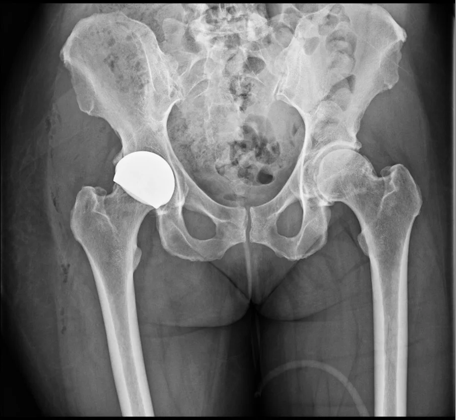 X-ray of a hip resurfaced with a ReCerf ceramic-on-ceramic cap, a bone-preserving option suitable for women, by Mr Shakir Hussain, Birmingham