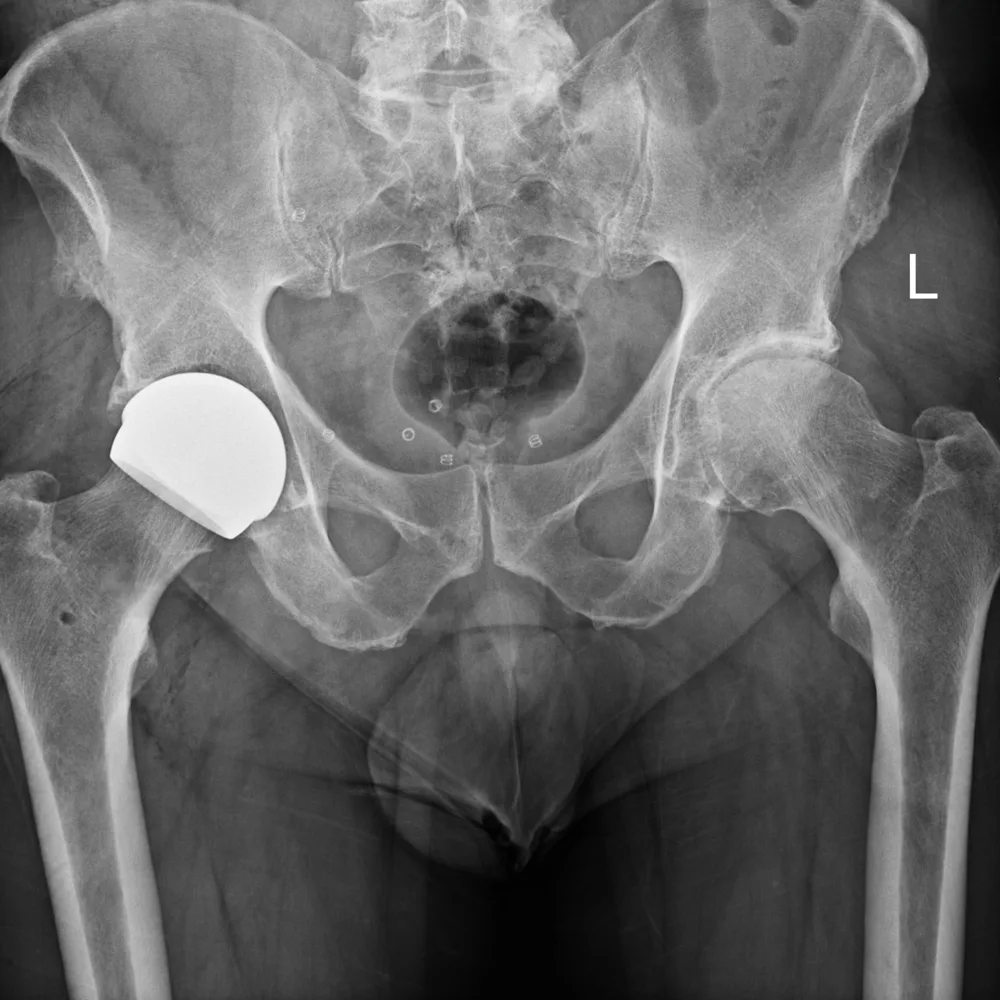 Post-operative X-ray of ceramic ReCerf hip resurfacing of the right hip, showing the resurfacing cap on the preserved femoral head and the matching cup in the socket, performed by Mr Shakir Hussain, Birmingham