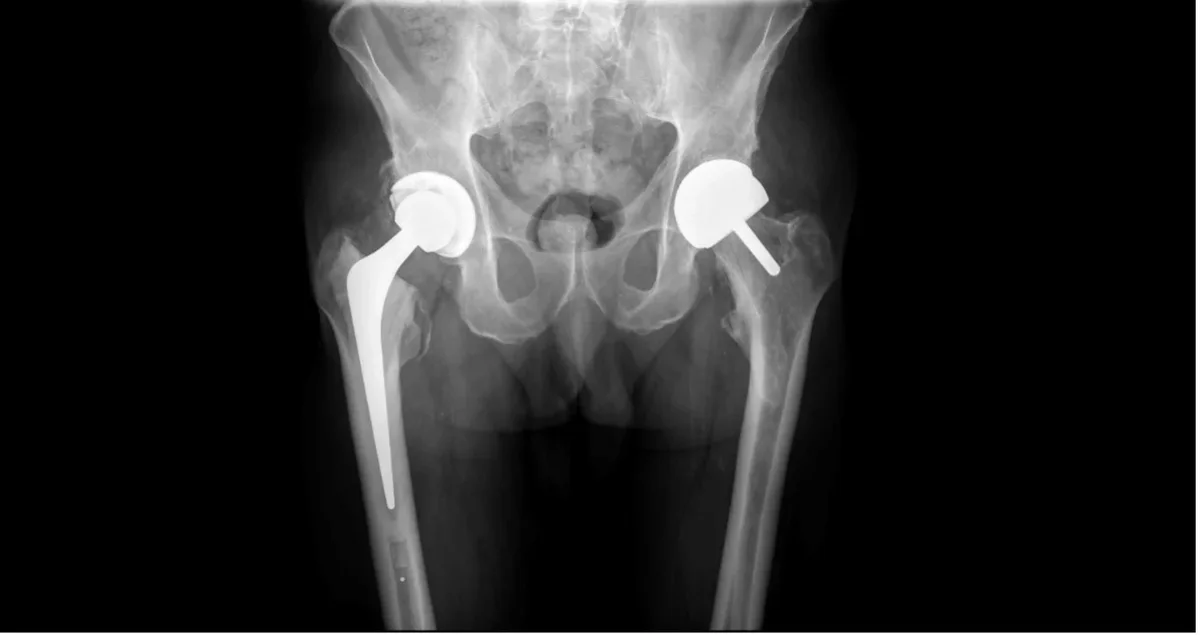 X-ray of one patient with both operations: a total hip replacement with a stem extending down the femur on one hip, and a bone-preserving hip resurfacing cap on the other, Mr Shakir Hussain, Birmingham