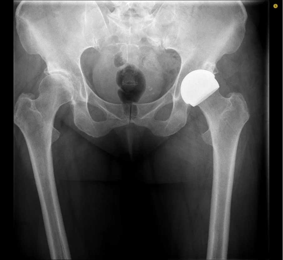 After X-ray showing a ReCerf ceramic-on-ceramic hip resurfacing cap implanted by Mr Shakir Hussain, Birmingham