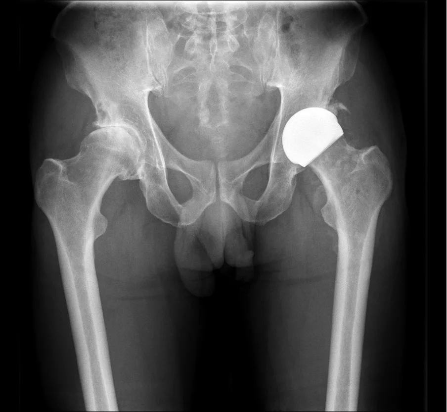 After X-ray showing a ReCerf ceramic hip resurfacing cap restoring the hip, by Mr Shakir Hussain, Birmingham