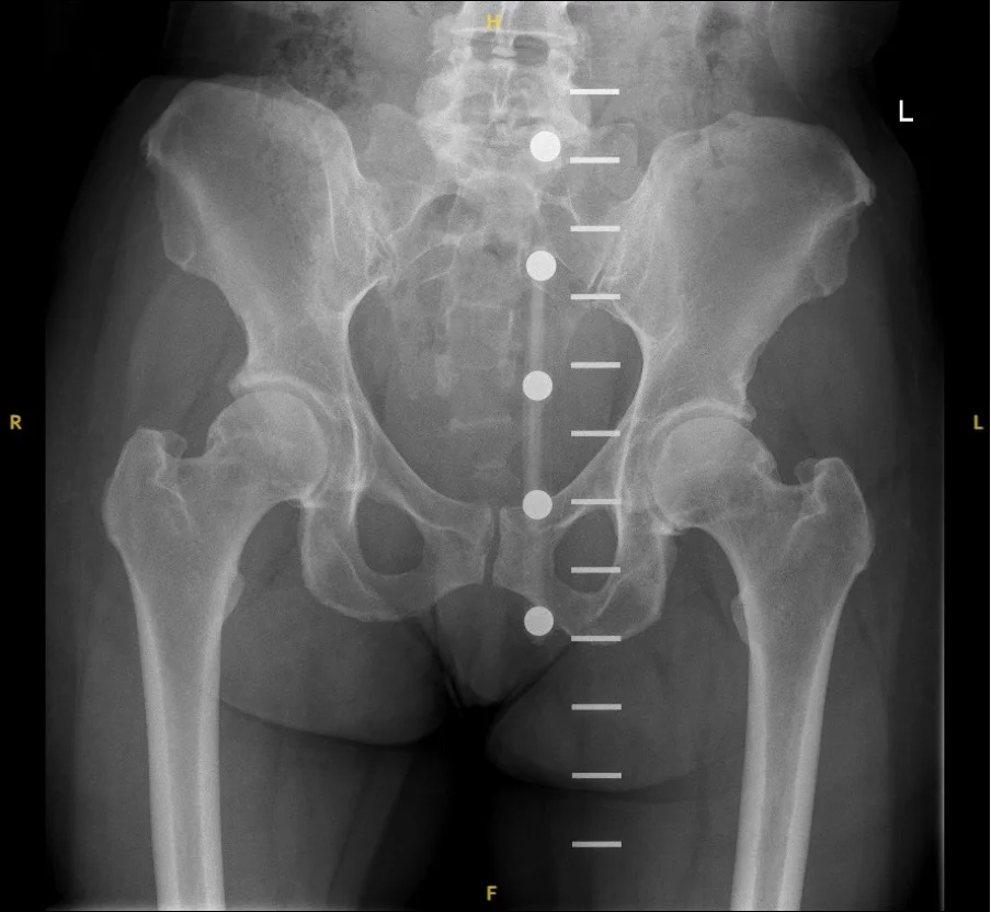 Before X-ray of an arthritic hip prior to ReCerf ceramic hip resurfacing by Mr Shakir Hussain, Birmingham