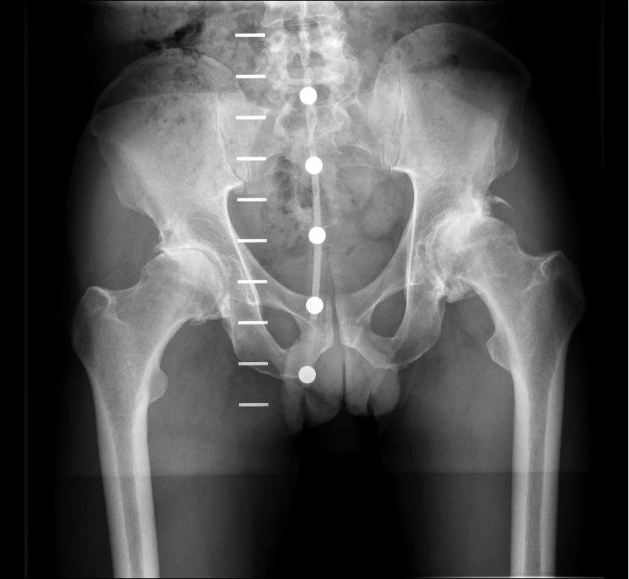 Before X-ray of a worn arthritic hip prior to ReCerf ceramic hip resurfacing by Mr Shakir Hussain, Birmingham