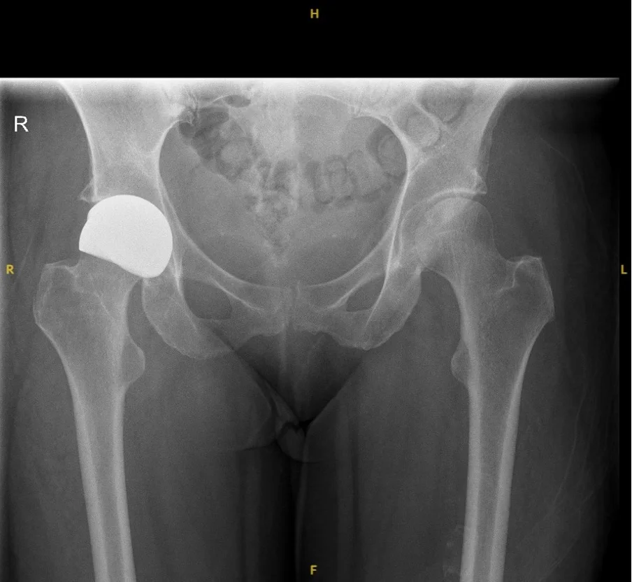 X-ray of a hip resurfaced with a ReCerf ceramic-on-ceramic cap by Mr Shakir Hussain, Birmingham