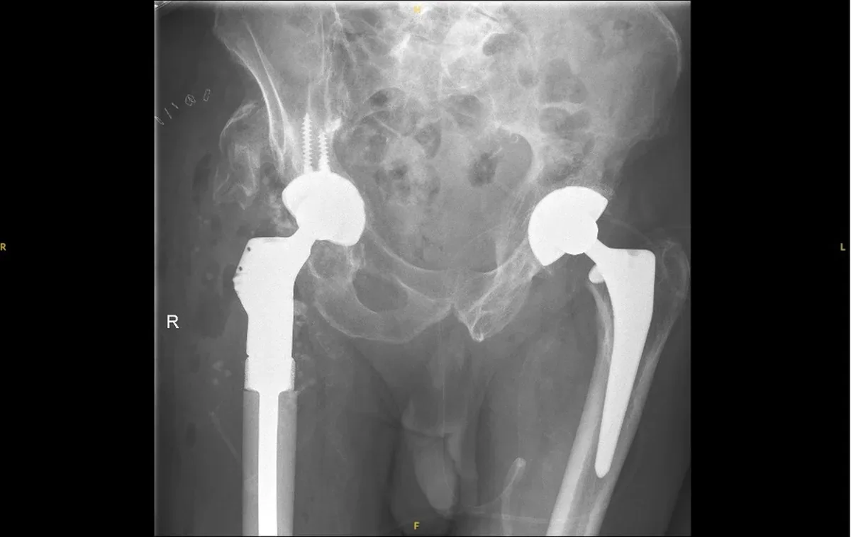 Post-operative X-ray of a revision total hip replacement using a long femoral stem to bypass bone loss, illustrating the more demanding revision of a stemmed hip replacement, Mr Shakir Hussain, Birmingham